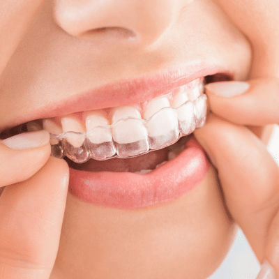 Explore discreet orthodontic solutions 3 Woman putting clear aligner on her front teeth as an orthodontic solution