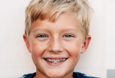 Our thoughts on pushing two-phase orthodontic treatment 3 Young boy smiling with short blonde hair, striped shirt, representing pushing two-phase orthodontic treatment